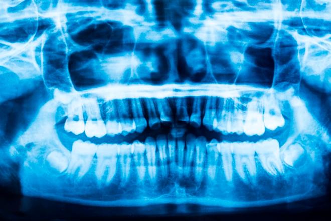 retrognatismo maxilar o mandibular