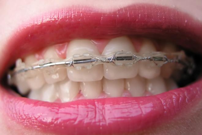 brackets transparentes, brackets de zafiro