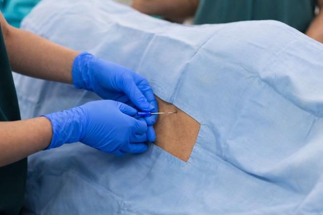 Qué es la punción lumbar