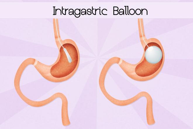 Todo lo que debes saber sobre el balón gástrico