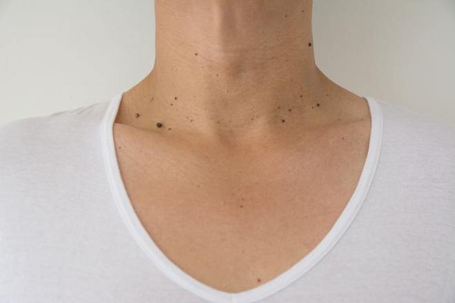 Quitar verrugas cuello