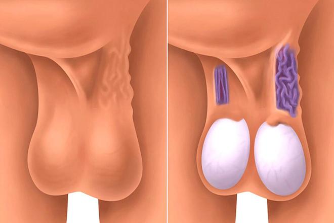 Infertilidad y varicocele