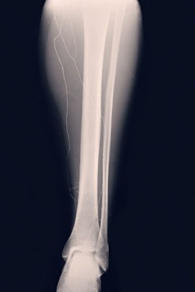 Imagen lesiones lesOsea estres tibia