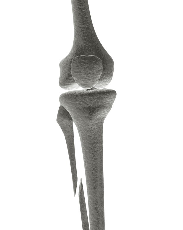 Fractura tibia y peroné