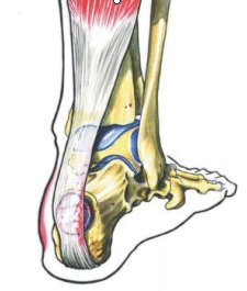 Imagen lesiones lesTend tendinitis aquiles