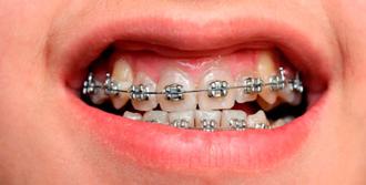brackets ortodoncia
