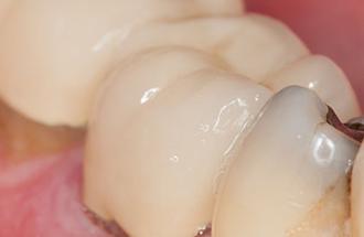 Enfermedad periodontal