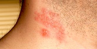 herpes Zóster