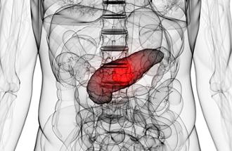 cáncer de páncreas
