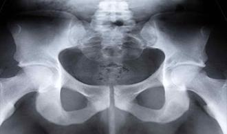 Imagen lesiones lesOsea artritis cadera