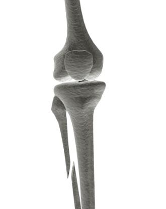 Imagen lesiones lesOsea tibia y perone