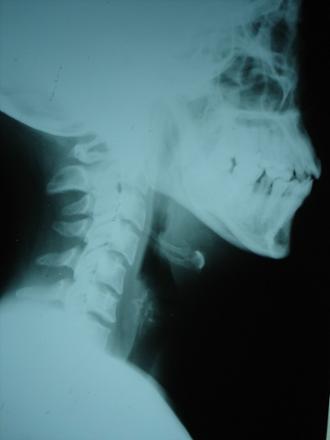 Imagen lesiones lesOsea traumatismo craneal