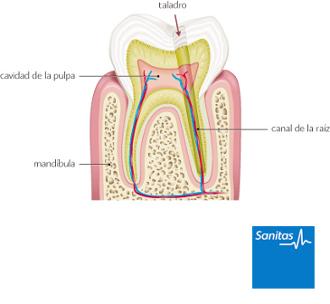 endodoncia cómo se realiza