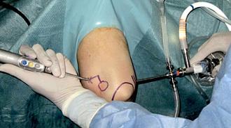 artroscopia de rodilla