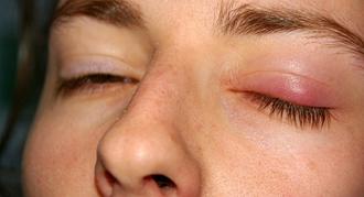 qué es la blefaritis