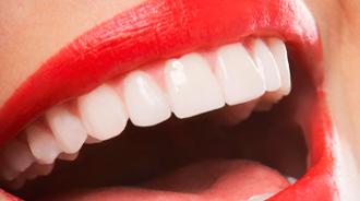 carillas dentales