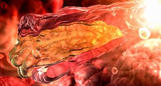 claudicación intermitente arterioesclerosis
