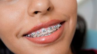 cómo funciona la ortodoncia