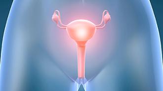 endometriosis e infertilidad