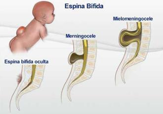 espina bífida