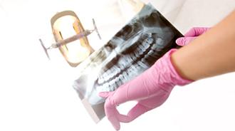 extracción muelas del juicio