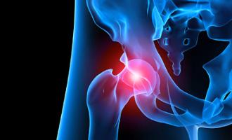 preguntas frecuentes sobre una fractura de cadera