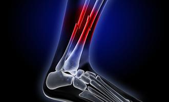 fractura de tibia