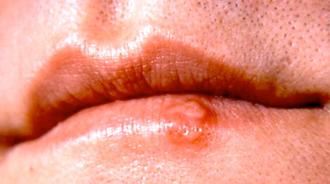 gerpes oral o labial