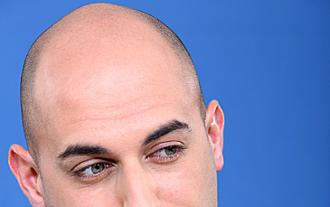 preguntas frecuentes sobre el implante de pelo