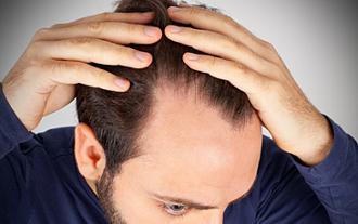 pros y contras del implante de pelo