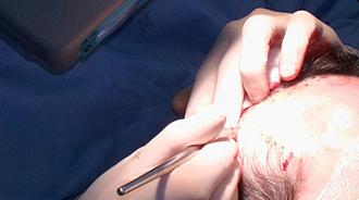 implante de pelo con la técnica FUE