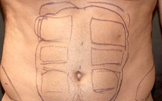 liposucción de abdomen en hombres