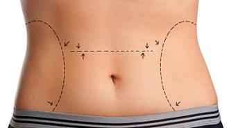 diferencias entre liposucción y lipoescultura