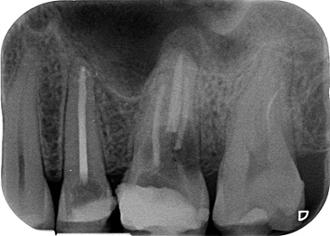 radiografía periapical