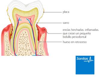 gingivectomía enfermedad gingival