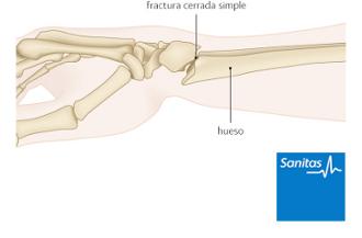fractura cerrada simple