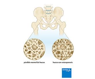 osteoporosis enfermedad huesos