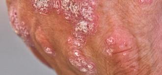 psoriasis enfermedad autoinmune