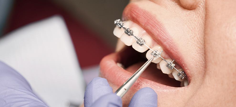 Elásticos en brackets metálicos