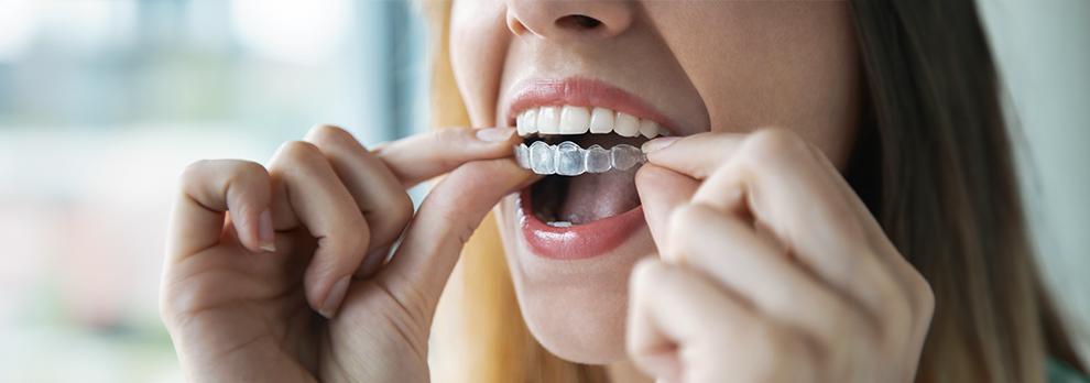 alineadores ortodoncia invisible