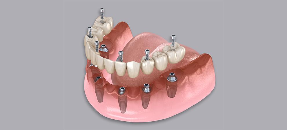 prótesis sobre implantes
