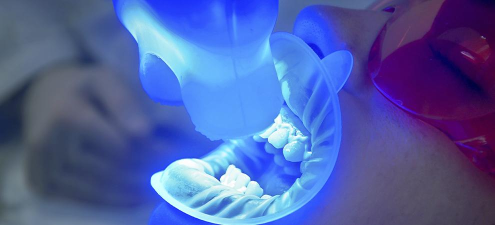 láser blanqueamiento dental
