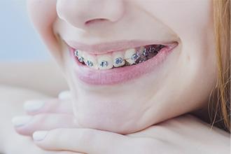 Ortodoncia Brackets Metálicos
